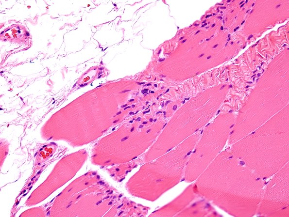 3A5 Myotendinous Junction (Case 3) H&E 4