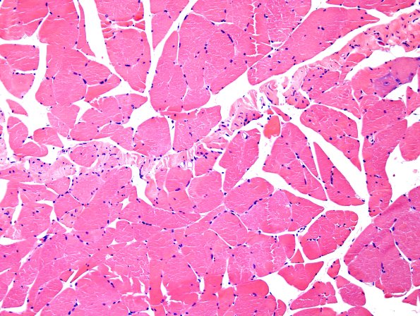 6A Tendon insert (Case 6) H&E 1