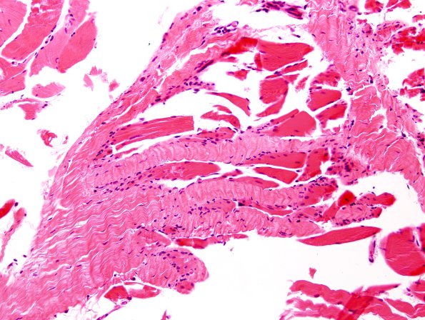 8A Tendon Insertion (Case 8)