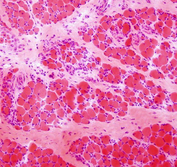 1A1 Nemaline Rod Myopathy (Case 1) H&E 2