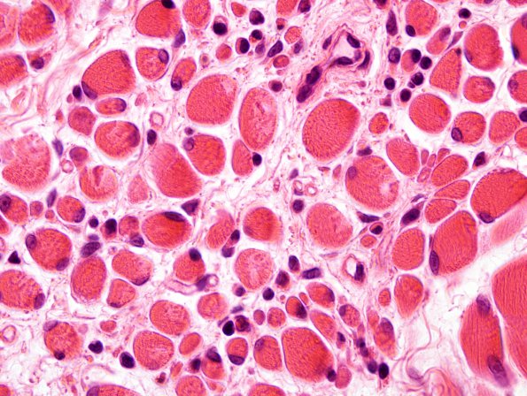 1A2 Nemaline Rod Myopathy (Case 1) H&E 3