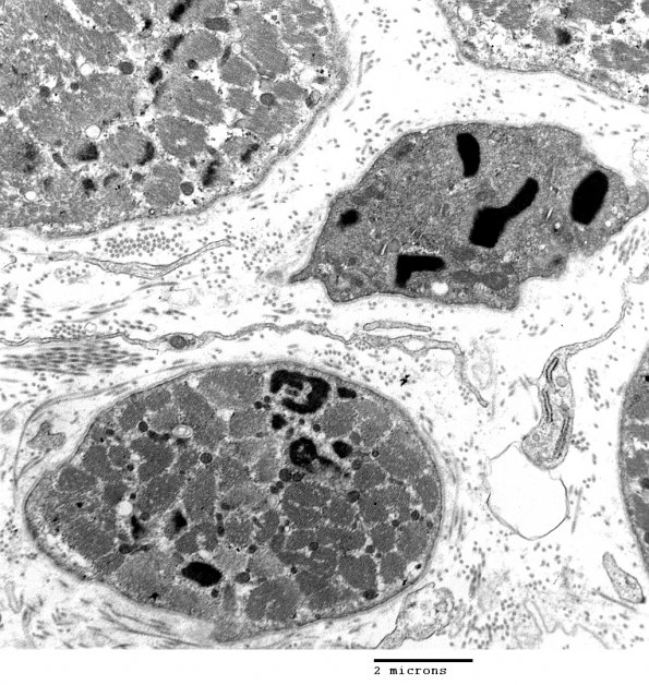 1D1 Nemaline Rod Myopathy (Case 1) EM 031 - Copy