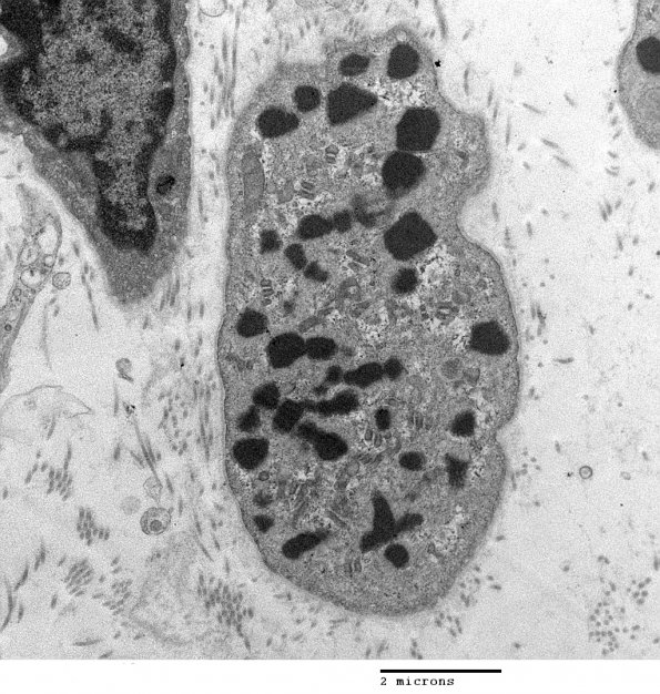 1D2 Nemaline Rod Myopathy (Case 1) EM 011 - Copy