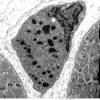 1D3 Nemaline Rod Myopathy (Case 1) EM 014 - Copy