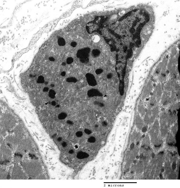 1D3 Nemaline Rod Myopathy (Case 1) EM 014 - Copy