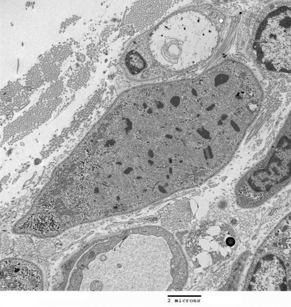 1D4 Nemaline Rod Myopathy (Case 1) EM 003 - Copy