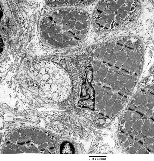 1A1 Normal, NMJ (Case 1) EM  039 - Copy