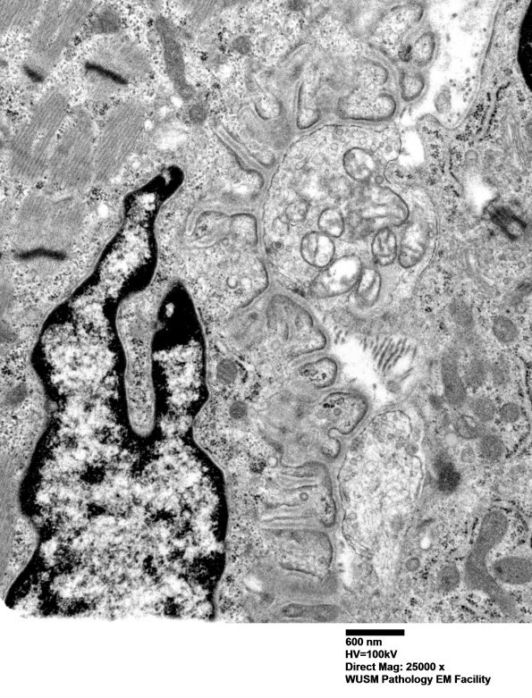 2A3 (Case 2) Muscle EM006 - Copy