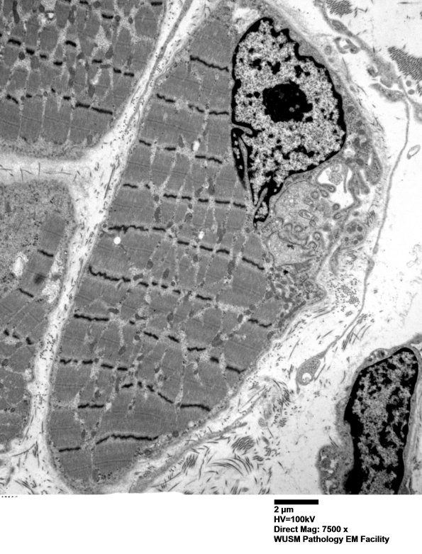 2B1 (Case 2) Muscle EMEM 014 - Copy