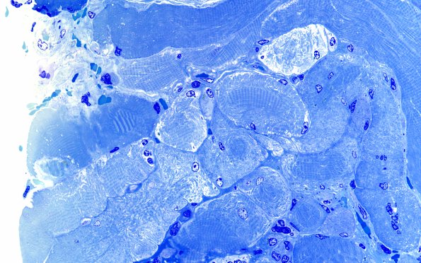 1F1 Atrophy 60X (Case 1) 60X 3