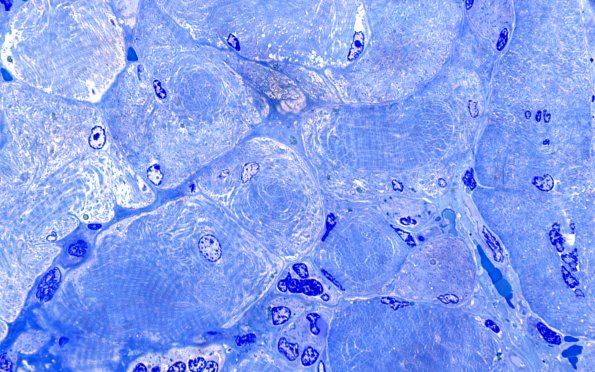 1F2 Atrophy 60X (Case 1) 60X 5