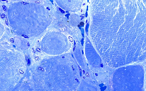 1F3 Atrophy 60X (Case 1) 100X 1