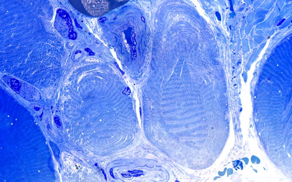 1F4 Atrophy 60X (Case 1) 100X 3