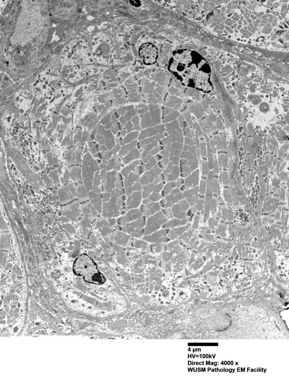 1G11A (Case 1) Muscle_022 - Copy