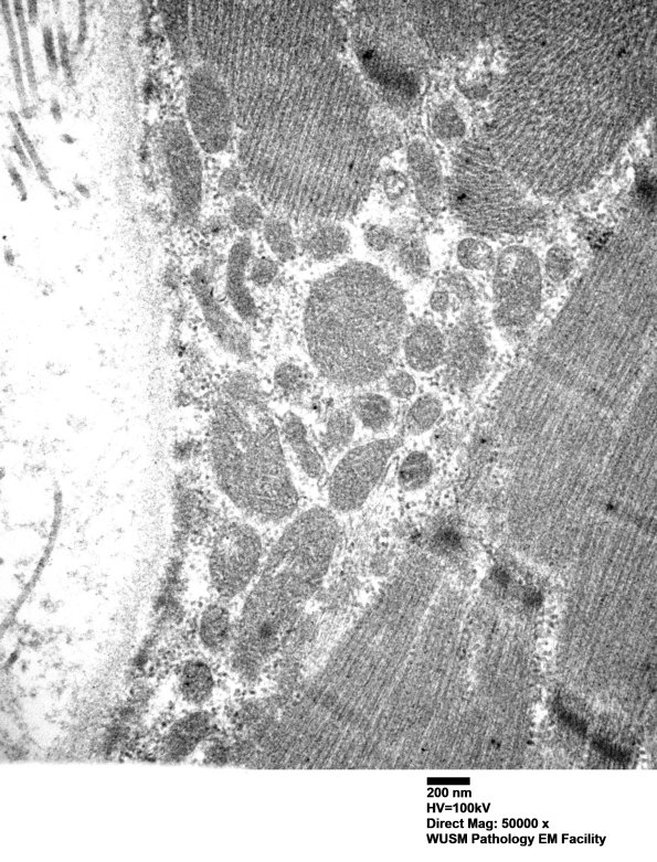 1G11D (Case 1) muscle_024 - Copy