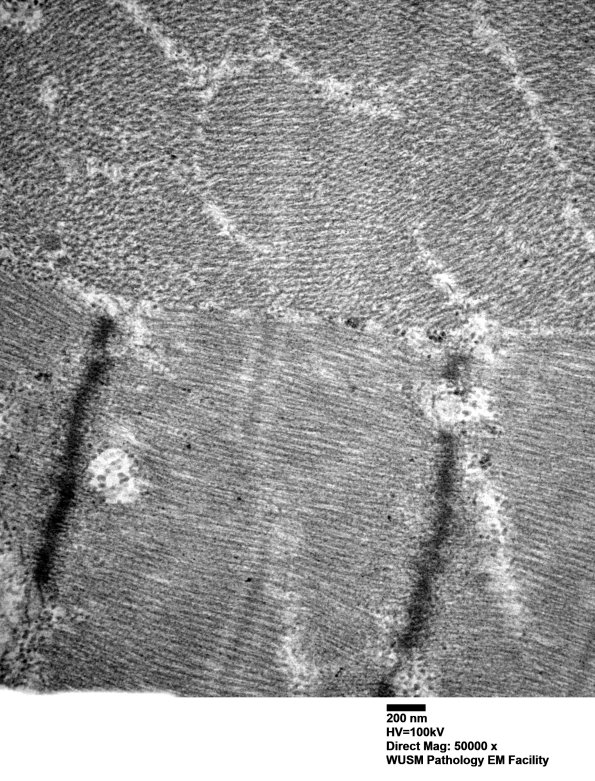 1G2C (Case 1) Muscle_042 - Copy
