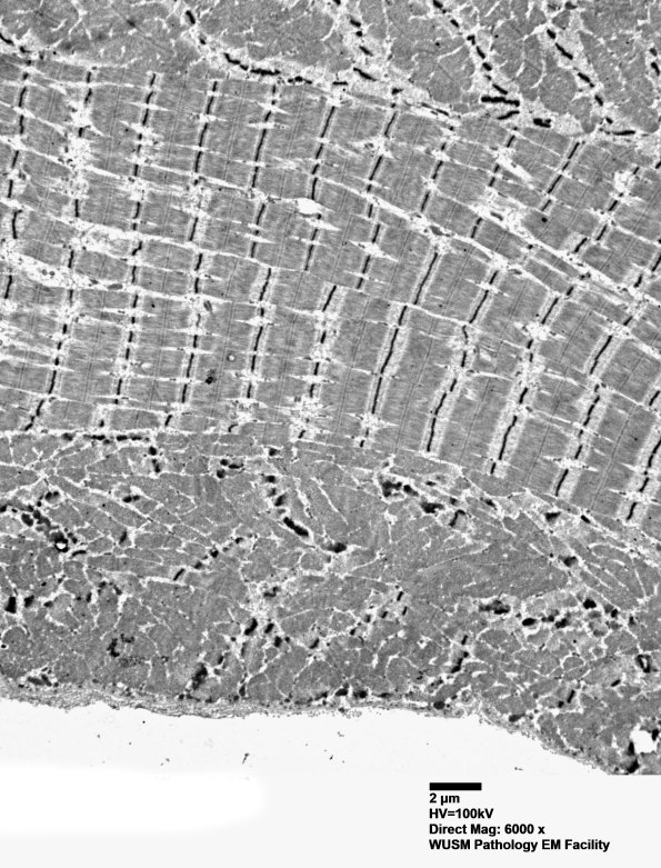 1G4A (Case 1) muscle_042 - Copy