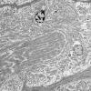 1G5A (Case 1) Muscle_002 - Copy