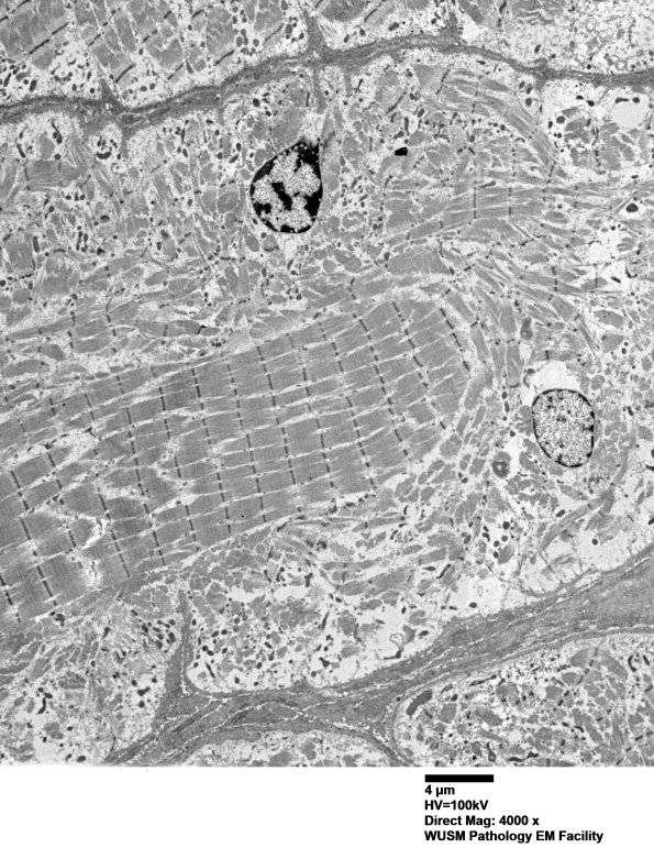 1G5A (Case 1) Muscle_002 - Copy