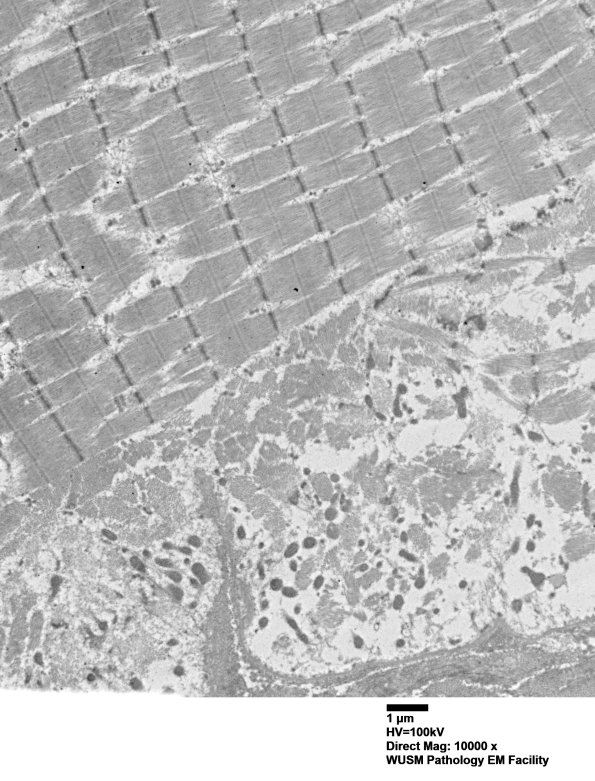 1G5B (Case 1) Muscle_006 - Copy