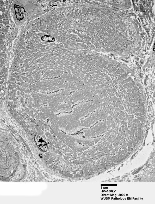 1G8A (Case 1) Muscle_036 - Copy