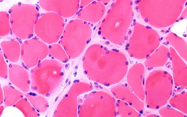 1A1B Targets (Case 1) H&E 40X copy