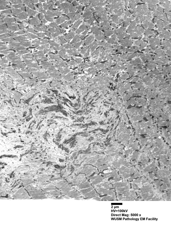 1J1A (Case 1 EM002 - Copy