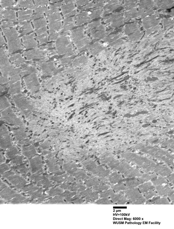 1J2A (Case 1 EM004 - Copy