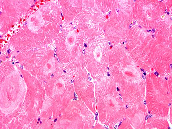 2A3 Neurogenic target fibers (Case 2)-H&E-1