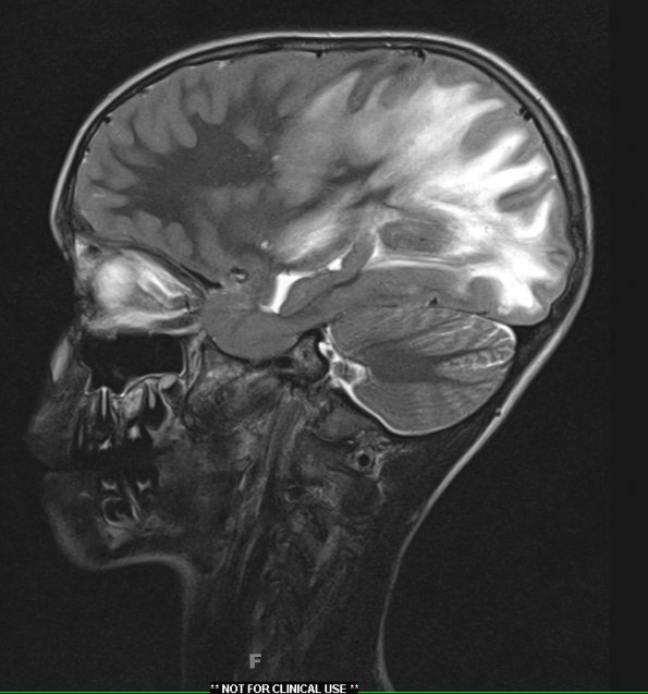 1A3 ADEM original surgery (Case 1) T2 with contrast