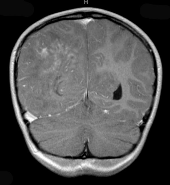 1A4 ADEM (Case 1) MRI 8 T1 W 1 - Copy