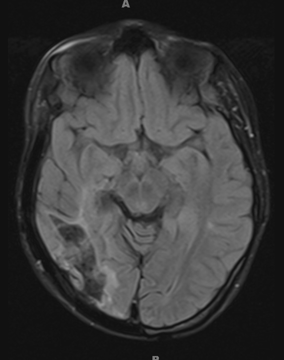 1H1 ADEM 10yr later (Case 1) FLAIR 1 - Copy