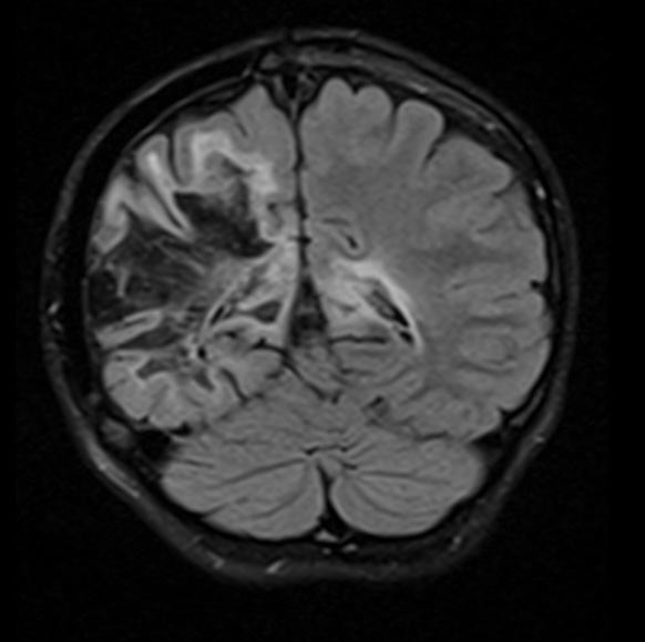 1H2 ADEM 10yr later (Case 1) FLAIR 2 - Copy