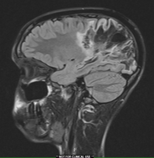 1H3 ADEM 10yr later (Case 1) FLAIR 3 - Copy