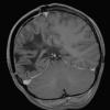 1H4 ADEM 10yr later (Case 1) T1 with contrast - Copy