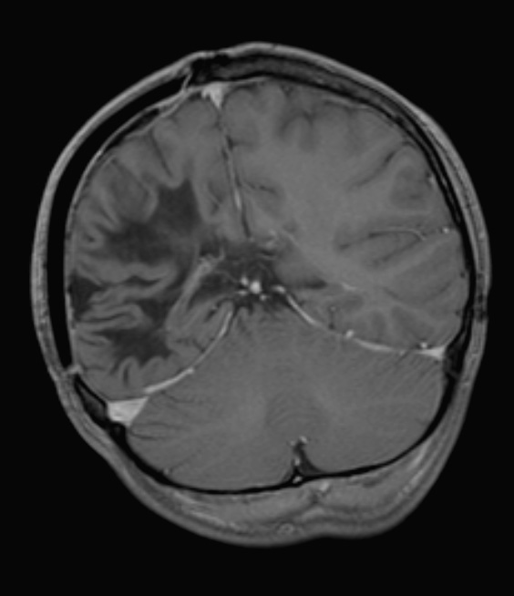 1H4 ADEM 10yr later (Case 1) T1 with contrast - Copy