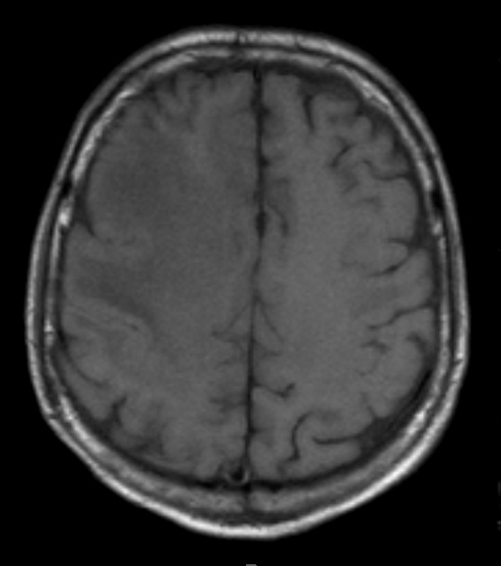 2A3 ADEM (Case 2) T1 no contrast - Copy