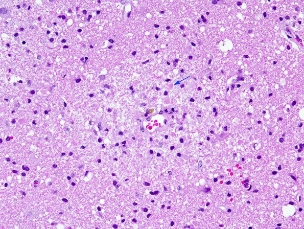 2B3 ADEM (Case 2) H&E 5 copy