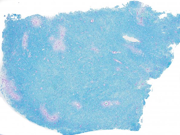 2C1 ADEM (Case 2) 1 LFB-PAS 4X