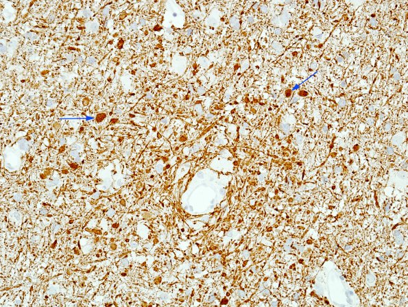 2D4 ADEM (Case 2) NFil copy