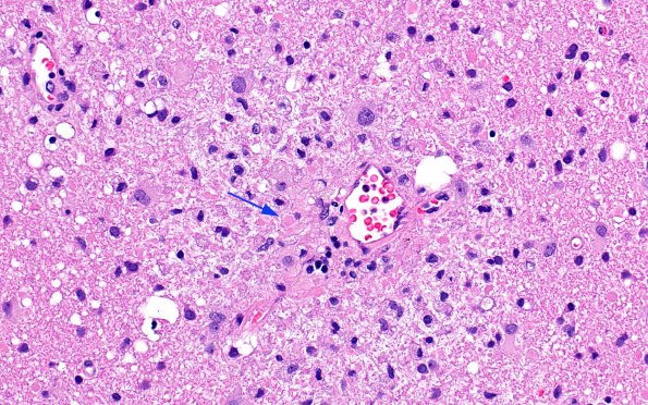 2F2 ADEM (Case 2) H&E correlate with LFB-PAS 40X 2 copy