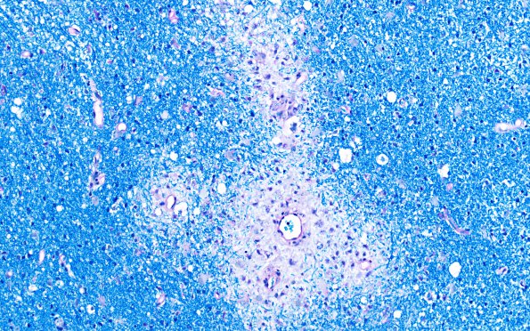 2F3 ADEM (Case 2) LFB-PAS 20X 2