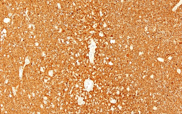 2F4 ADEM (Case 2) NF correlate with LFB-PAS 20X 2