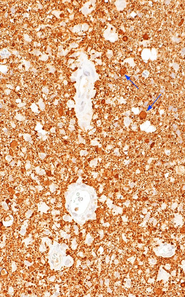 2F5 ADEM (Case 2) NF correlate with LFB-PAS 40X 2 copy