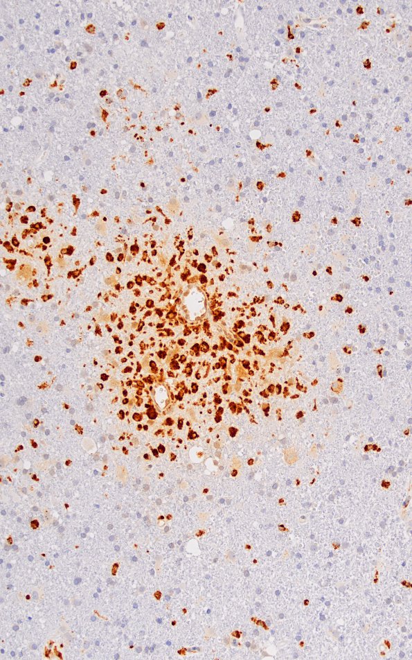 2F6 ADEM (Case 2) CD68 correlate with 20X new