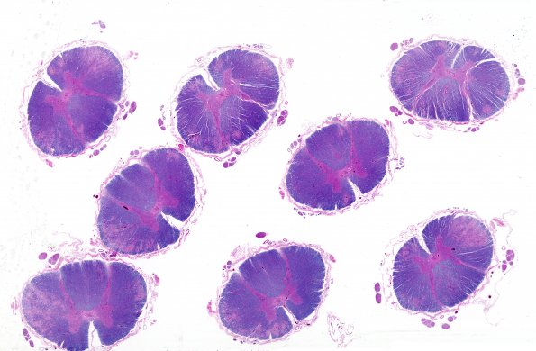 3A1 ADEM (but no Encephalon) (CANP 2004-Case 7) LFB-PAS WM 1