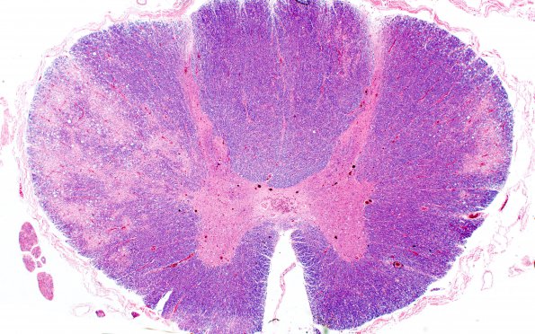 3A2 ADEM (but no Encephalon) (CANP 2004-Case 7) LFB-PAS A 2X