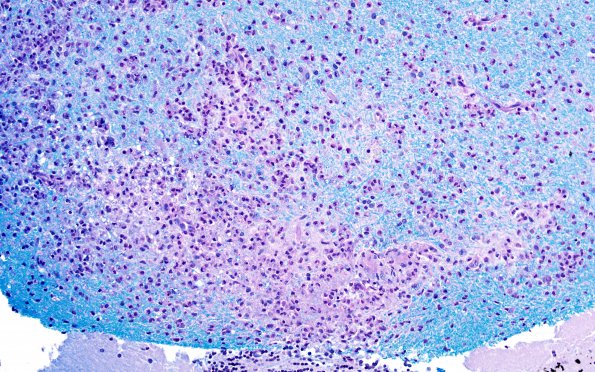 4B3 ADEM (Case 4) LFB-PAS 20X left lesion