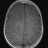 5A2 ADEM (Case 5) T1 without Contrast 1 - Copy