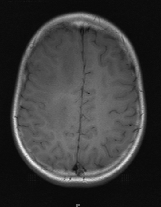 5A2 ADEM (Case 5) T1 without Contrast 1 - Copy